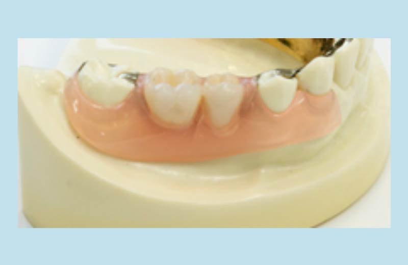 特殊樹脂義歯（ノンメタルクラスプデンチャー）