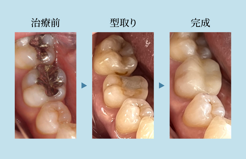 奥歯ラミネートベニア（オーバーレイ）の参考画像