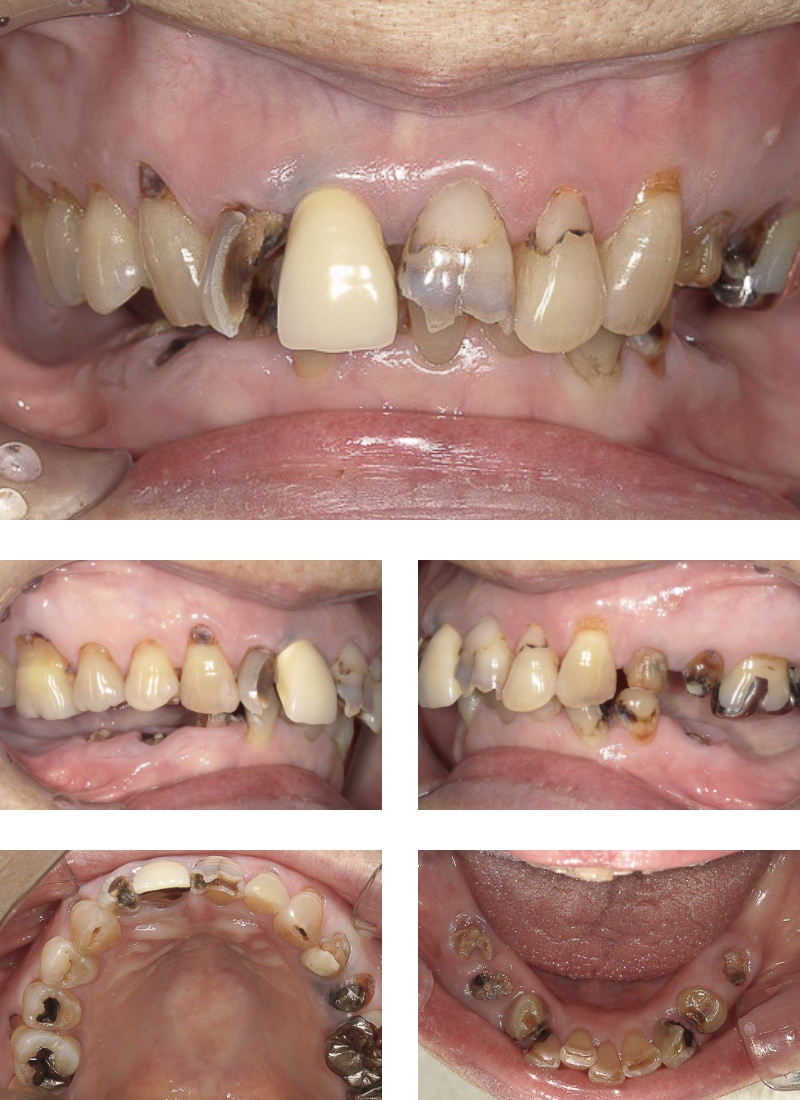 虫歯治療、嚙み合わせ改善、義歯装着、治療前の写真