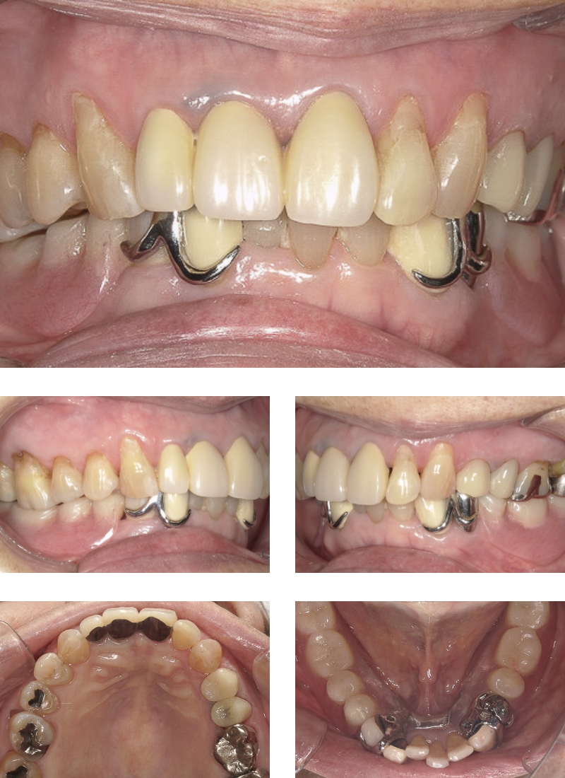 虫歯治療、嚙み合わせ改善、義歯装着、治療後の写真