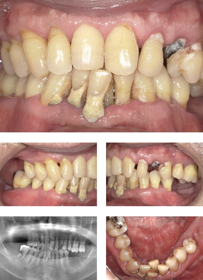 歯周病治療、噛み合わせ改善、義歯装着、治療前の写真