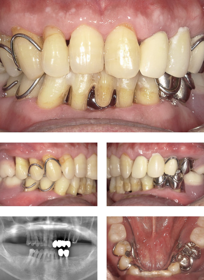 歯周病治療、噛み合わせ改善、義歯装着、治療後の写真