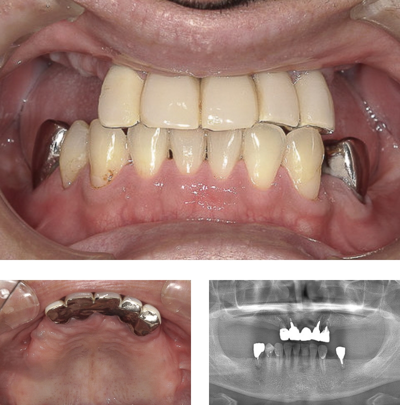インプラント、義歯の維持機構（バー）、金属床義歯、治療前の写真