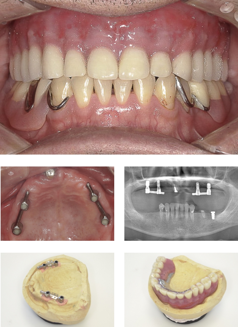 インプラント、義歯の維持機構（バー）、金属床義歯、治療後の写真