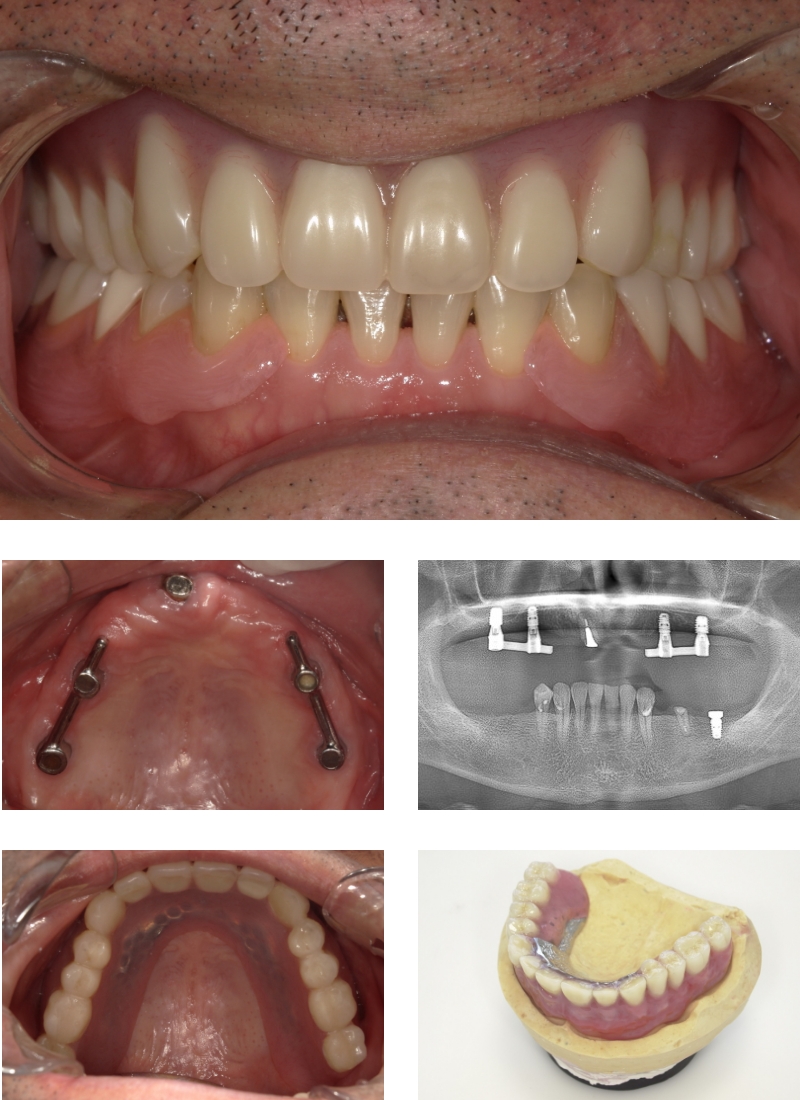 インプラント、義歯の維持機構（バー）、金属床義歯、治療後の写真