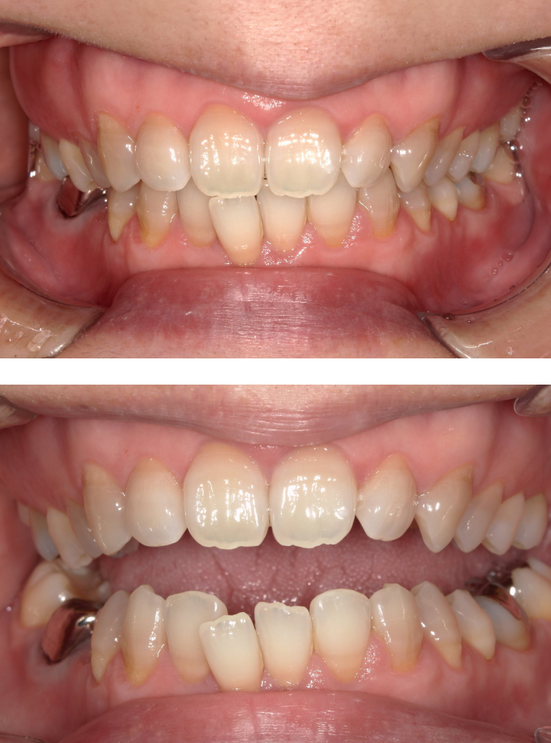 マウスピース矯正-3⼈⽬の症例-矯正前の写真