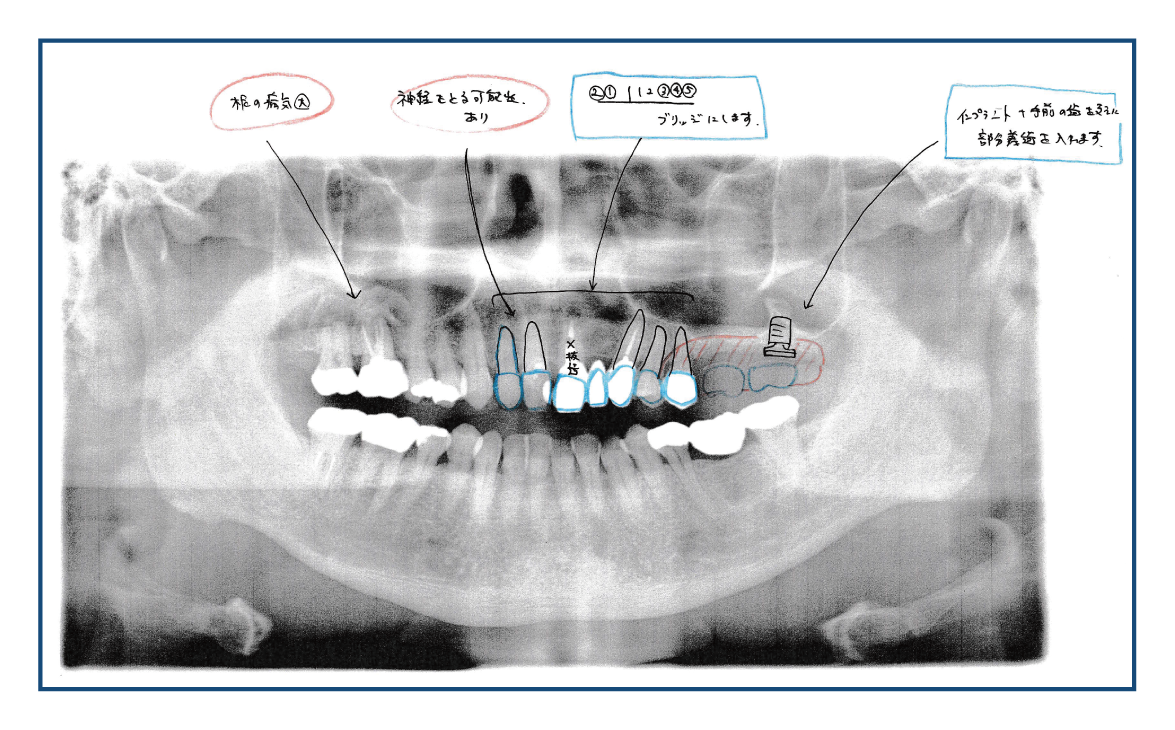 患者B様の治療計画-計画Aの写真