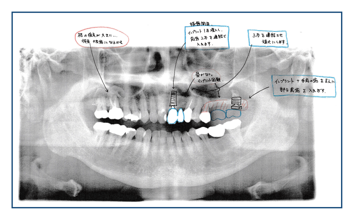 患者B様の治療計画-計画Bの写真