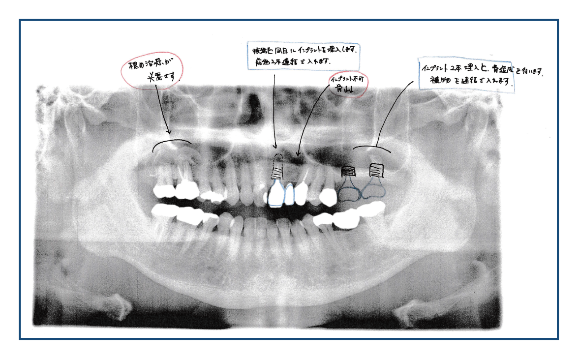 患者B様の治療計画-計画Cの写真